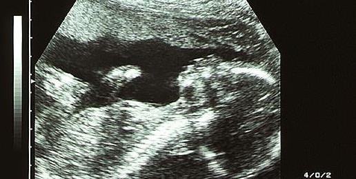 Neurobiologist Tells Senate Committee Unborn Babies Feel Pain at 20 Weeks