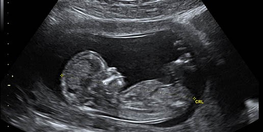 Ultrasounds Showing Life to Abortion-Minded Parents [VIDEO]